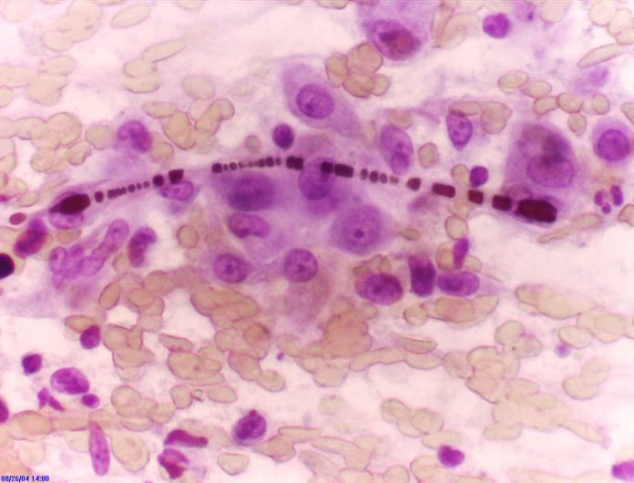 carcinoma