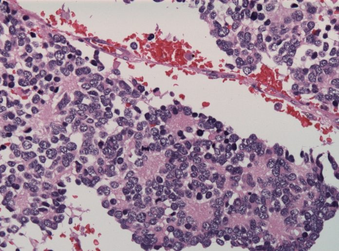 Terapia CAR-T GD2: nuova svolta nel trattamento del neuroblastoma