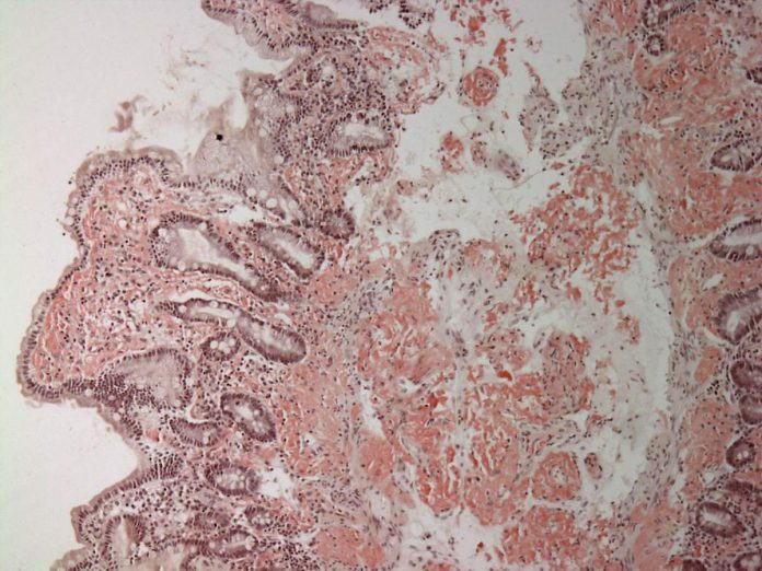 Amiloidosi cardiaca, il registro nazionale che cambia la cura in Italia